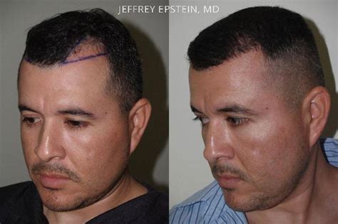 Hair Transplants For Men Pictures Miami Fl Paciente 39965