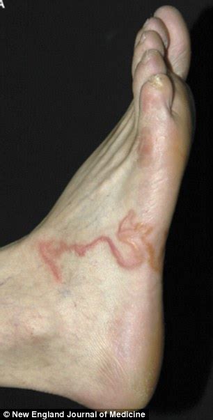The Varicose Vein That Was Actually A Worm Daily Mail Online