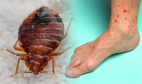 Bed Bug Bites One Of The Signs You Shouldnt Ignore And How To Get Rid