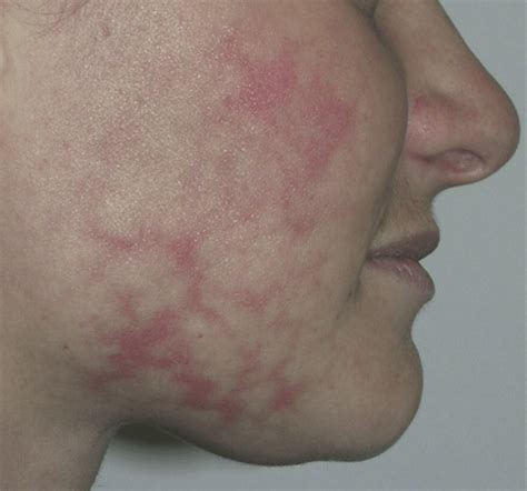Reticulate Erythematous Patch With Peripheral Telangiectasia On The