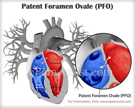 What Is Patent Foramen Ovale Pfocausessymptomstreatmentdiagnosis