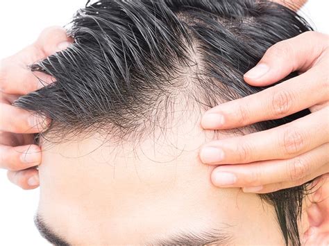 Greffe de cheveux, comment ça marche