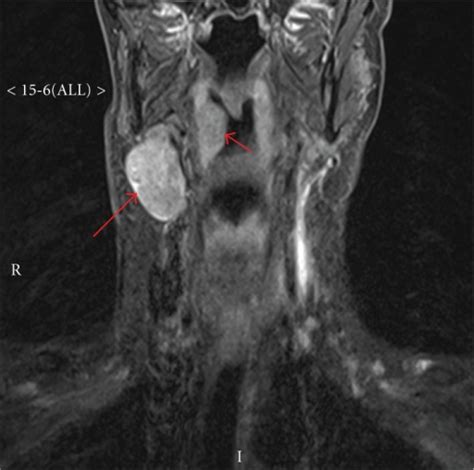 Swollen Lymph Nodes In Neck Ultrasound