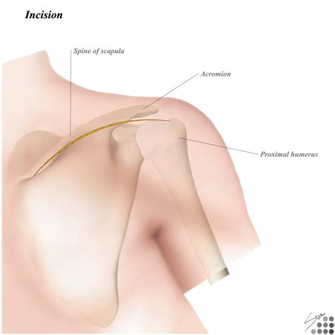 Posterior To Shoulder Approaches Orthobullets