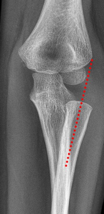Pediatric Elbow Dislocation Radsource