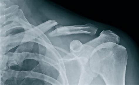 Breaking A Collarbone What To Do I Love Bicycling