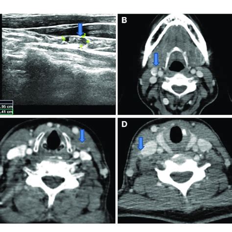 A Lateral Neck Lymph Node With Microcalcification On Download