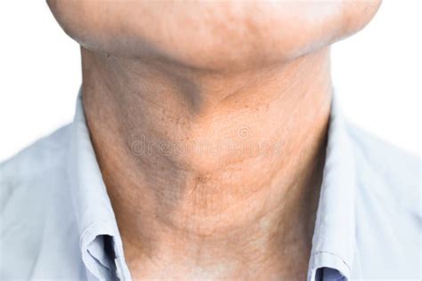 Goiter Is A Lump Or Swelling At The Front Of The Neck Caused By A