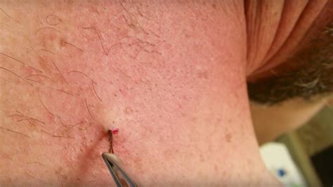 This Viral Video Of A Six Year Old Ingrown Hair Being Removed Is