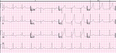 Dr Smiths Ecg Blog 5 Hours Of Chest Pain How Acute Is The Stemi