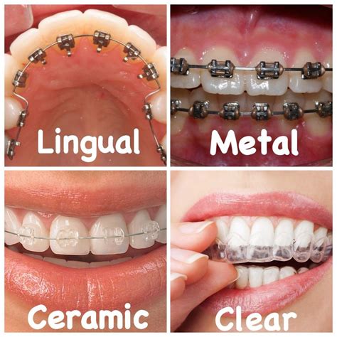Orthosmile Multispeciality Dental Clinic Types Of Orthodontic Braces