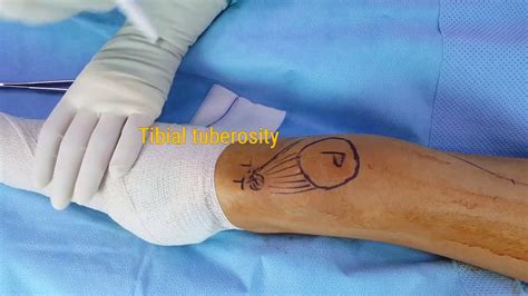 Distal Femur Resection And Endoprosthetic Replacemnt Surgical