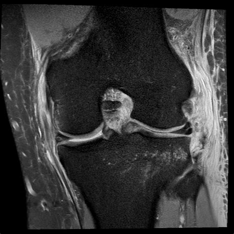 Knee Muscle Anatomy Mri Injuries And Chronic Conditions Of The Knee