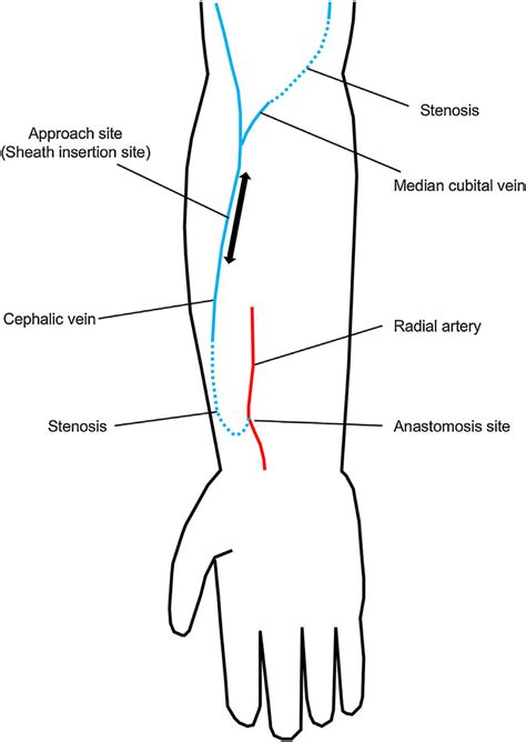 A Schematic Illustration Of The Arteriovenous Fistula In The Patients