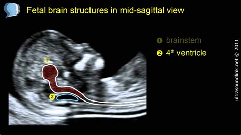 Normal Fetal Brain Anatomy At 11 13 Weeks 2d Scan Youtube