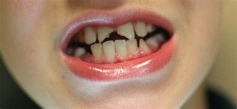 Dental Procedures To Repair A Broken Tooth