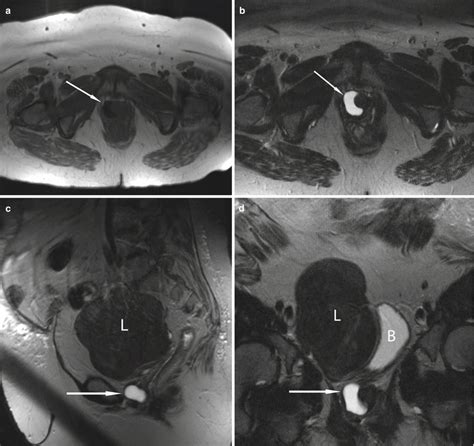 Cross Sectional Imaging Of The Female Urethra Radiology Key