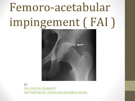 Femoroacetabular Impingement Syndrome