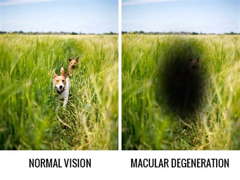 Changes In Your Eyes After Age 40 Macular Degeneration