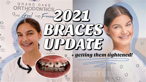 Braces Update 2021 Getting My Braces Tightened My Braces Advice 🦷 Youtube