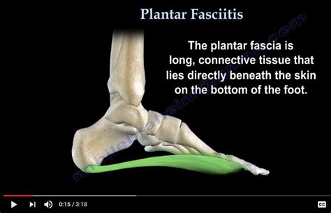Plantar Fascitis Dnb Orthopaedics Ms Orthopedics Mrcs Exam Guide