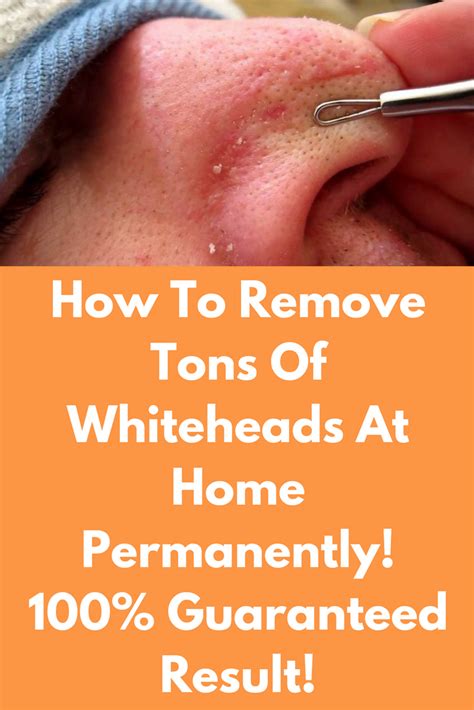 How To Remove Tons Of Whiteheads At Home Permanently 100 Guaranteed