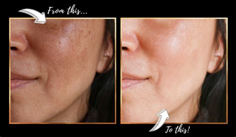 What Is The Difference Between Melasma And Blotchy Pigmentation