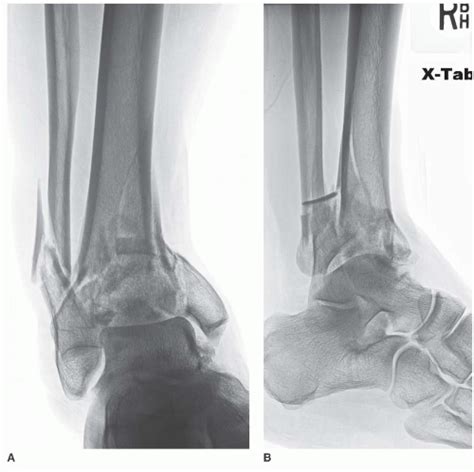 Tibial Pilon Fractures Staged Internal Fixation Musculoskeletal Key