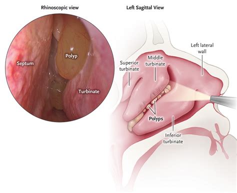 What Are Nasal Polyps How Is It Diagnosed And Treated Diag