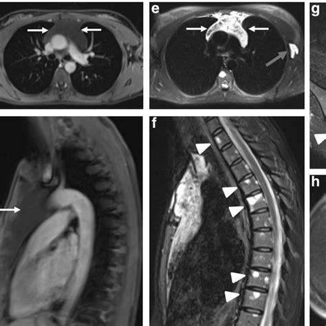 Histology Of The Left Axillary Cystic Lesion A Dilated And Cystic