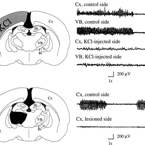 E Ects Of Cortical Functional Inhibition And Thalamic Lesion On The