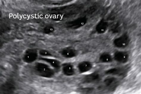 They may bleed, rupture, or twist the so you can have polycystic ovaries without having pcos. Polycystic ovary syndrome: Women tell their stories of the ...
