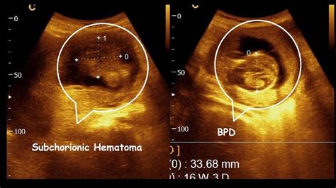 Subchorionic Hematoma 16 Weeks Live Pregnancy Amader Hospital