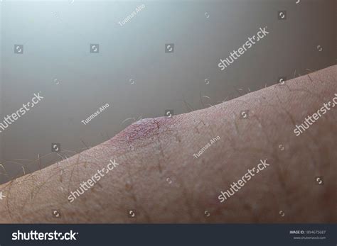 Lump On Inside Thigh