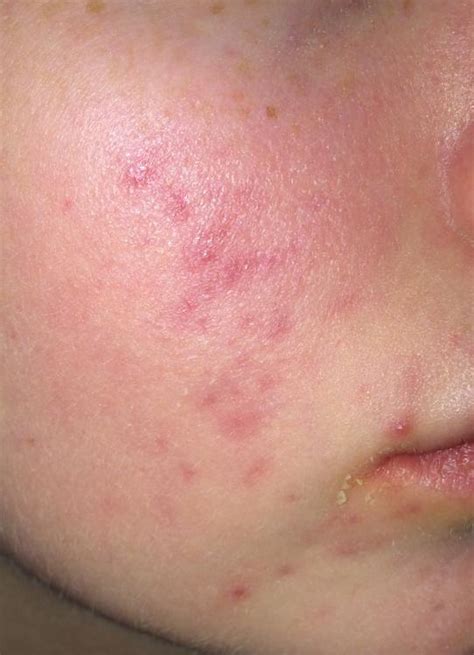 Bila anda menghendaki cara yang lebih instan, anda bisa melakukan konsultasi dengan dokter kulit untuk penanganan lebih lanjut. Cara Menghilangkan Bekas Jerawat dengan Laser Toning