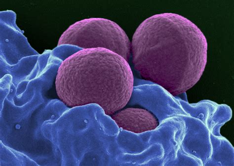 Common Antimicrobials Help Patients Recover From Mrsa Abscesses