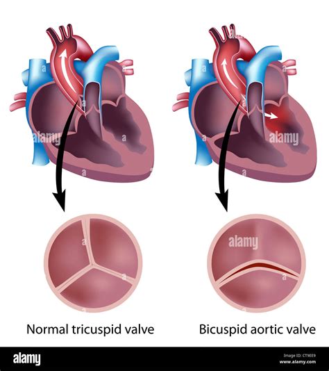 Heart Valve Defect Bicuspid Aortic Valve Stock Photo 49381425 Alamy