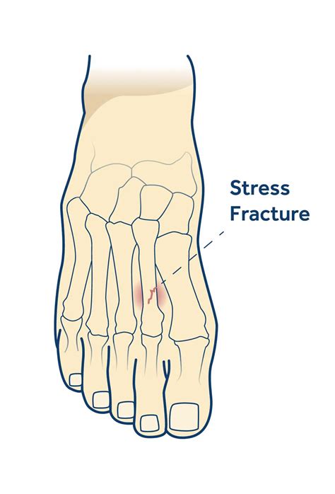 Stress Fractures Shellharbour Podiatry Your Local Podiatrists