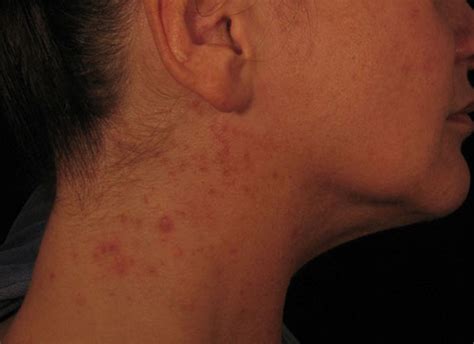 Learn about the potential side effects of vitamin c (ascorbic acid). Florid Rash Caused by Vitamin B12 Injections Administered ...