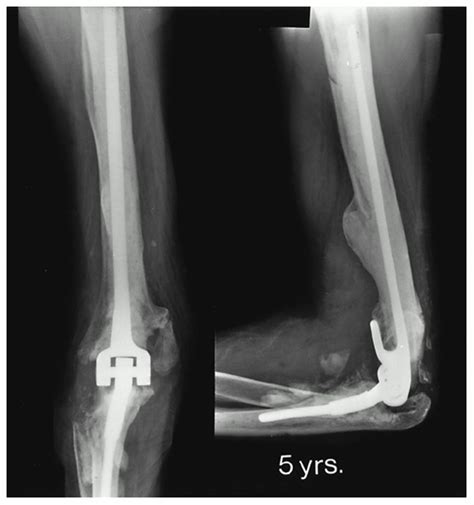 Total Elbow Arthroplasty Revision With Use Of A Non Custom Jbjs