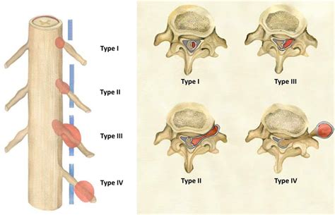 Morphological Relation Of Peripheral Nerve Sheath Tumors And Nerve