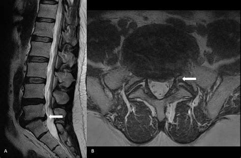 Herniated Disc Mri L5 S1 Lumbar Herniated Disc A More In Depth Look