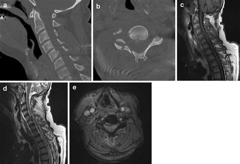 Trauma Of The Spine And Spinal Cord Imaging Strategies Springerlink