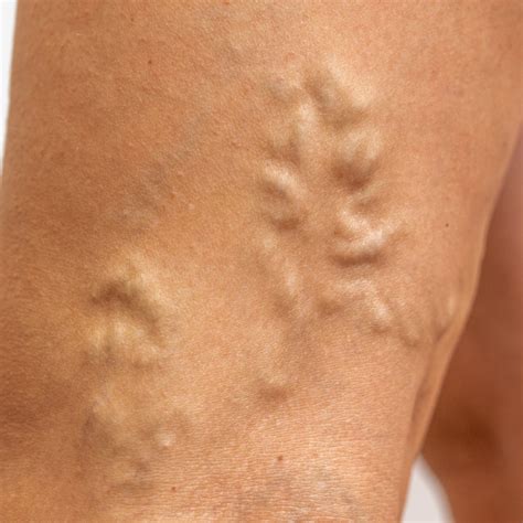 What Is Vein Mapping The Vein Center Of Maryland