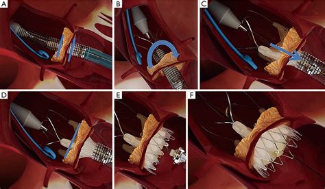 Transcatheter Aortic Valve Implantation Tavi In Patients With Aortic