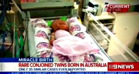 Rare Conjoined Twins With One Body And Two Faces Born In Australia