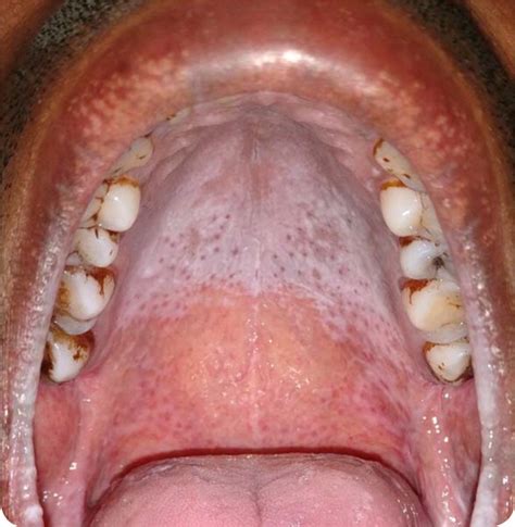 Swollen Salivary Glands Roof Of Mouth