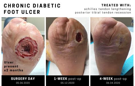 Diabetic Foot Care Next Step Foot And Ankle Clinic