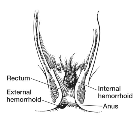 rectum and anus with internal and external hemorrhoid labeled media asset niddk