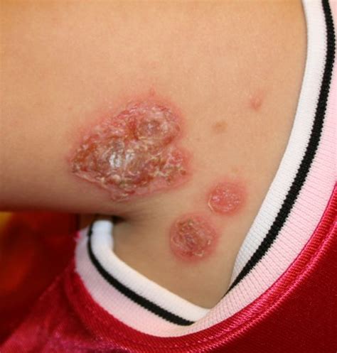 Mrsa Infection Pictures Causes Symptoms Treatment Prevention